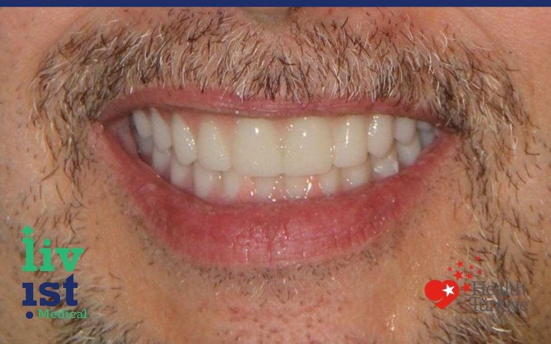 After: Severe Cases