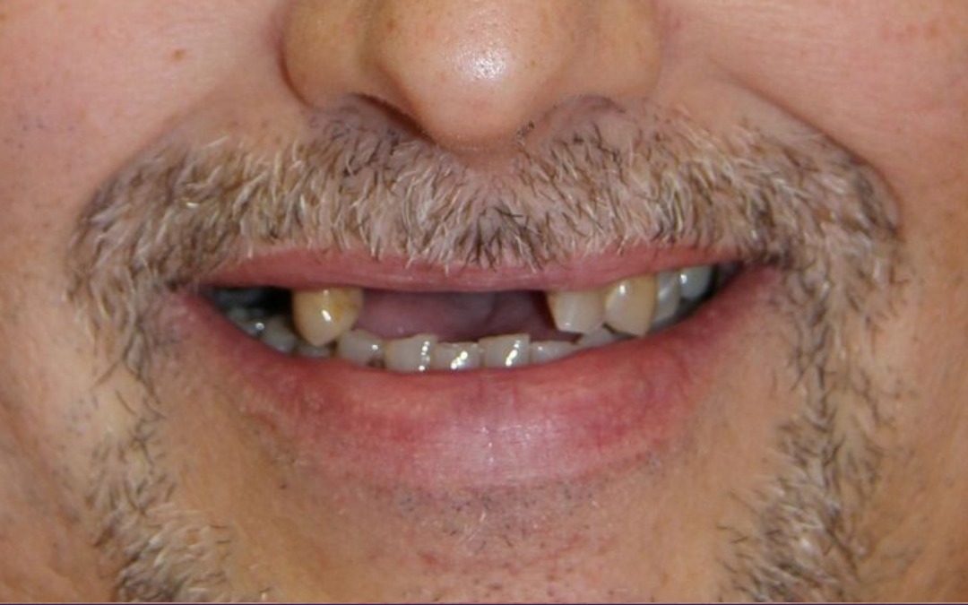 Before: Severe Cases