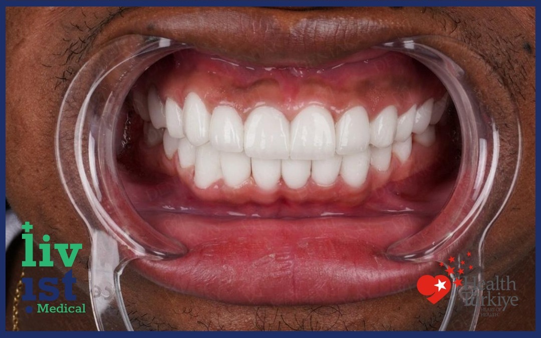 After: Digital Smile Design Cost