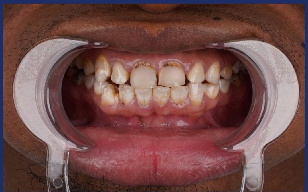 Before: Digital Smile Design Cost