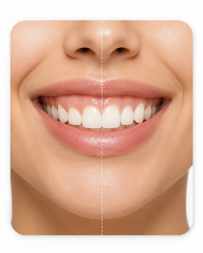 Gummy Smile Correction