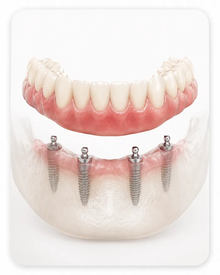 Implant-Supported Dentures