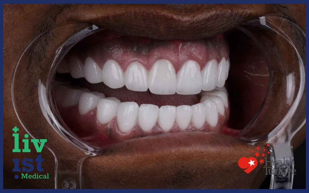 After: Gum Disease Treatment Cost
