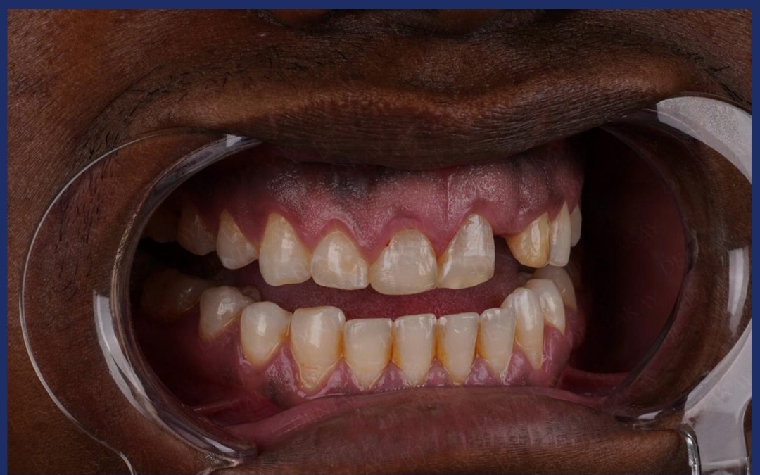 Before: Gum Disease Treatment Cost