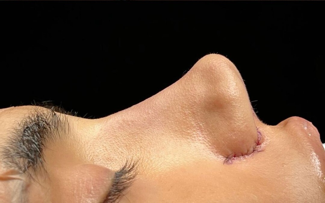 After: Rhinoplasty Cost