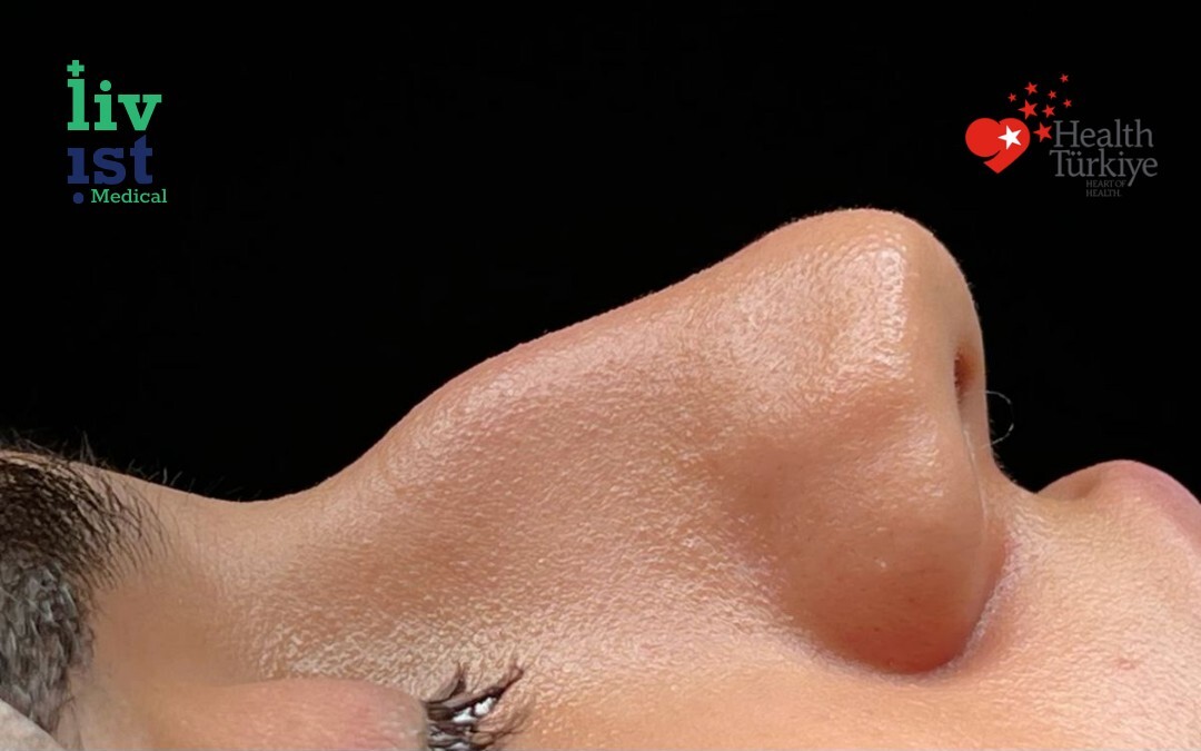 Before: Rhinoplasty Cost