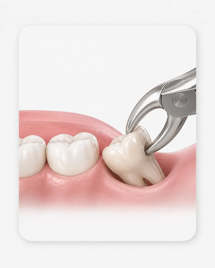 Wisdom Teeth Extraction