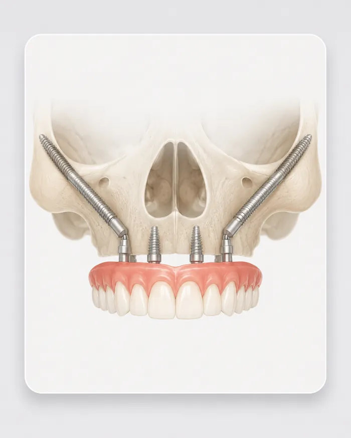 Zygomatic Implants